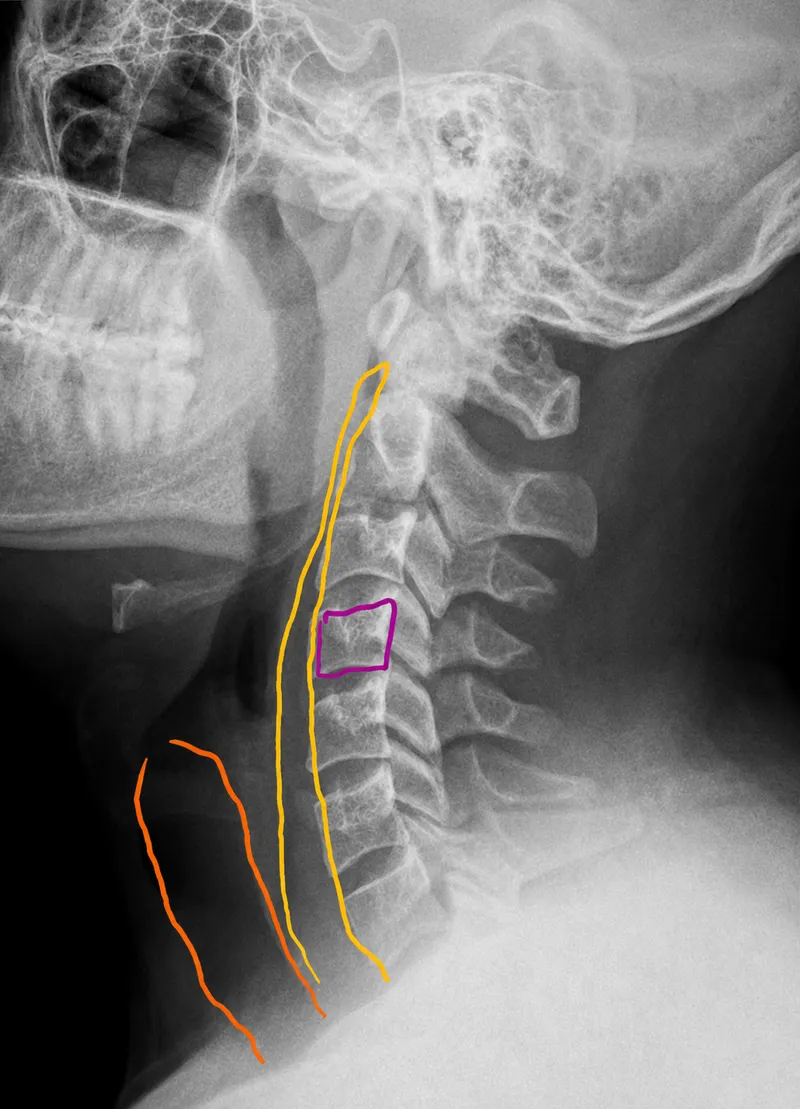 Lateral Cervical Spine X-ray with Soft Tissue