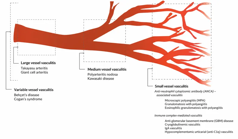 Vasculitis Classification by Vessel Size