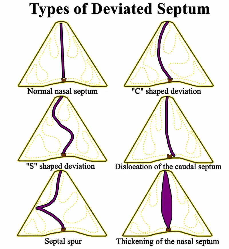 Types of Deviated Nasal Septum