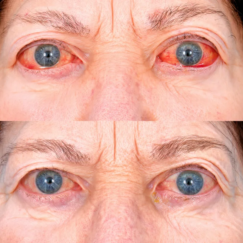 Thyroid Eye Disease: Before and After Treatment