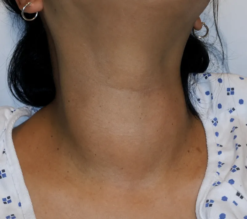Palpable neck mass