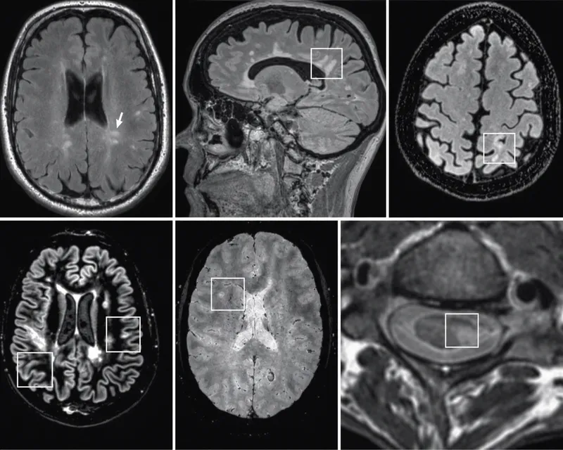 MRI showing demyelinating plaques in Multiple Sclerosis