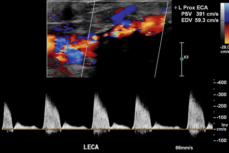 Carotid Duplex Ultrasound with Stenosis and Turbulent Flow