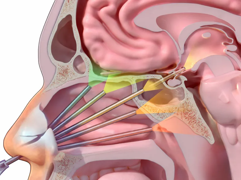 Endoscopic Endonasal Approach to Skull Base