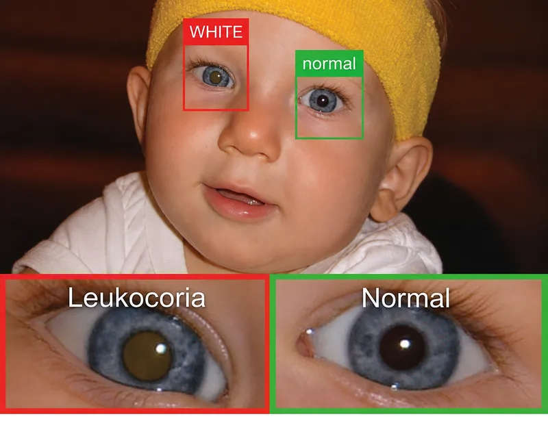 Leukocoria vs Normal Red Reflex in Infant Eye