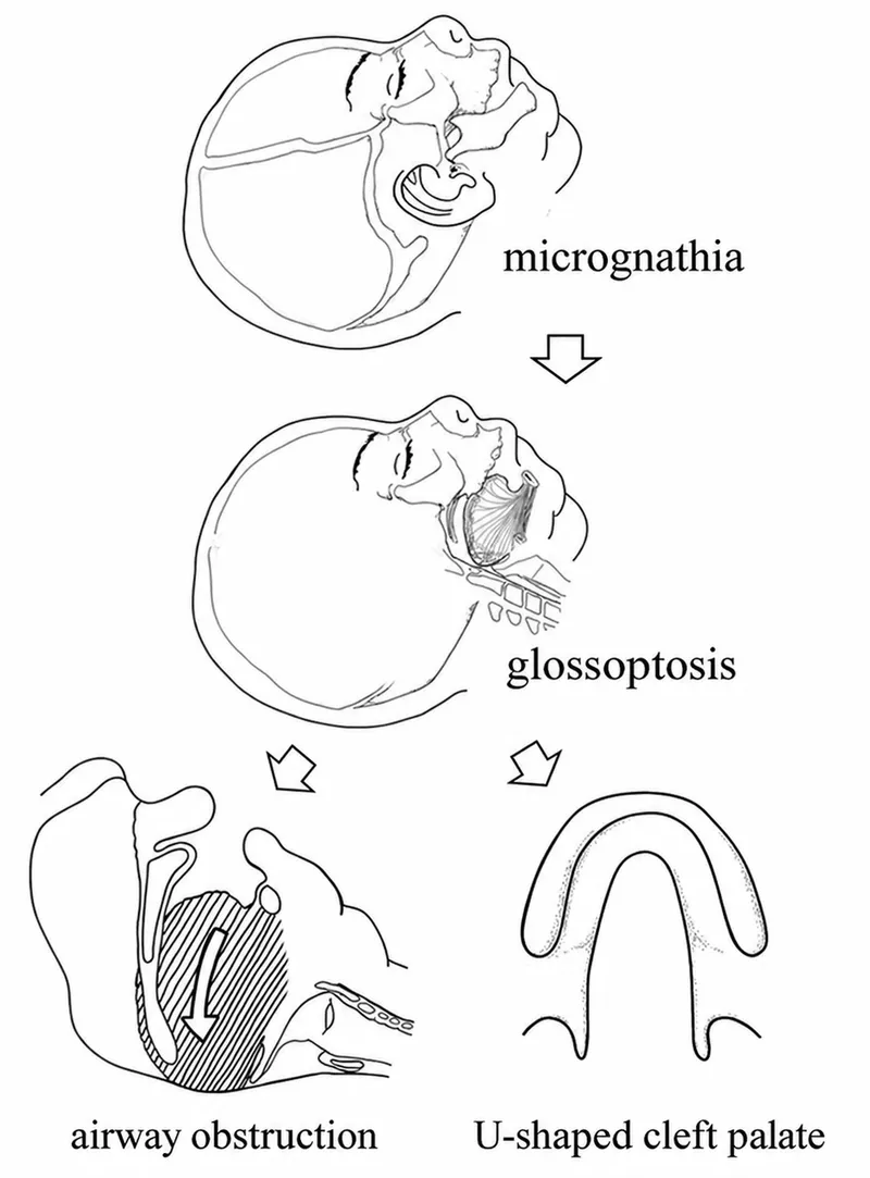Pierre Robin Sequence triad and airway obstruction