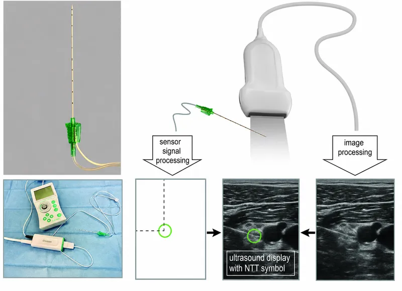 Ultrasound-guided needle placement for nerve block