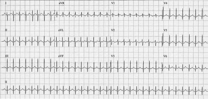 ECG: Narrow Complex SVT in 2-month-old