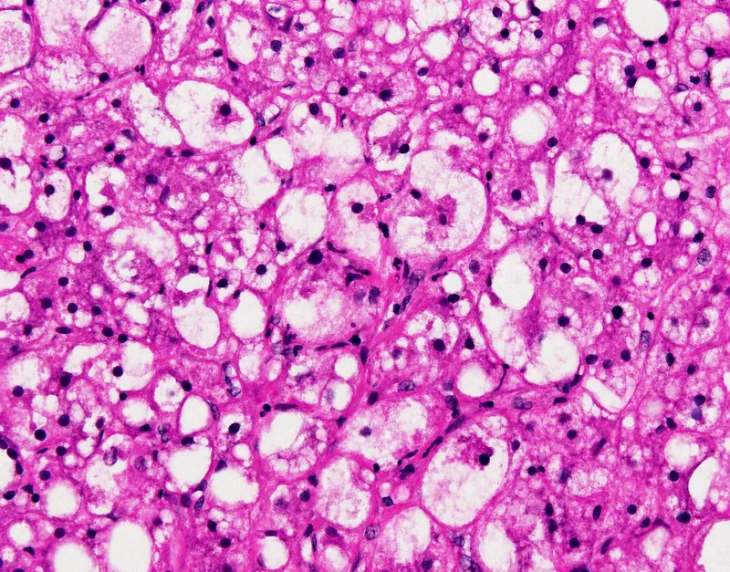 Histopathology of NASH with ballooning degeneration