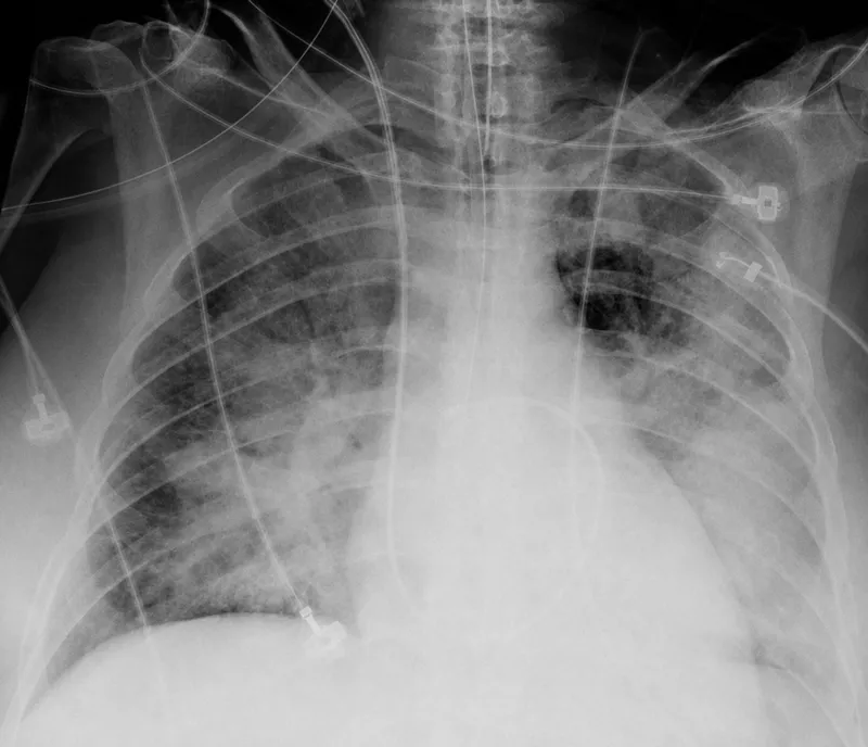 Chest X-ray: Pulmonary Edema with Batwing Appearance