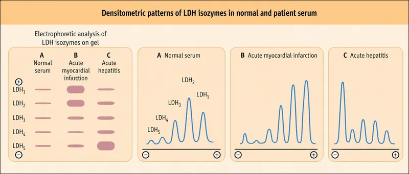 LDH isoenzyme patterns in normal serum, MI, and hepatitis