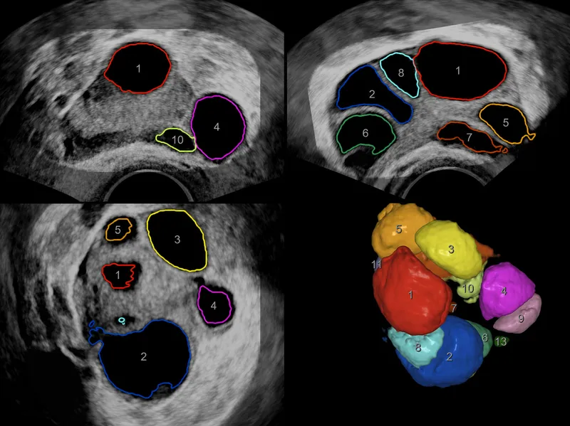 Transvaginal ultrasound of antral follicles