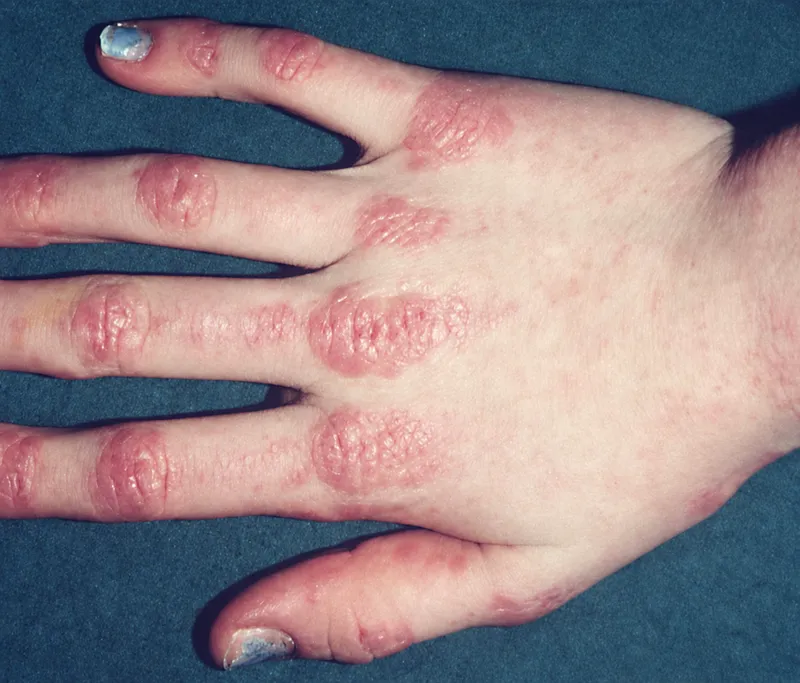 Gottron papules on hand in dermatomyositis