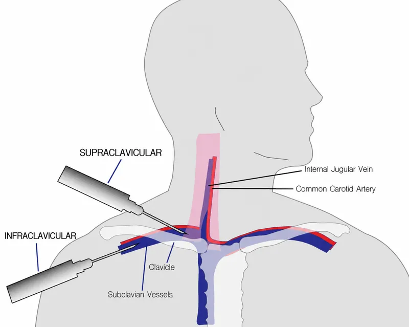 Central Line Insertion Landmarks: IJV, Subclavian, Femoral