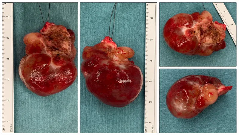 Gross appearance of atrial myxoma