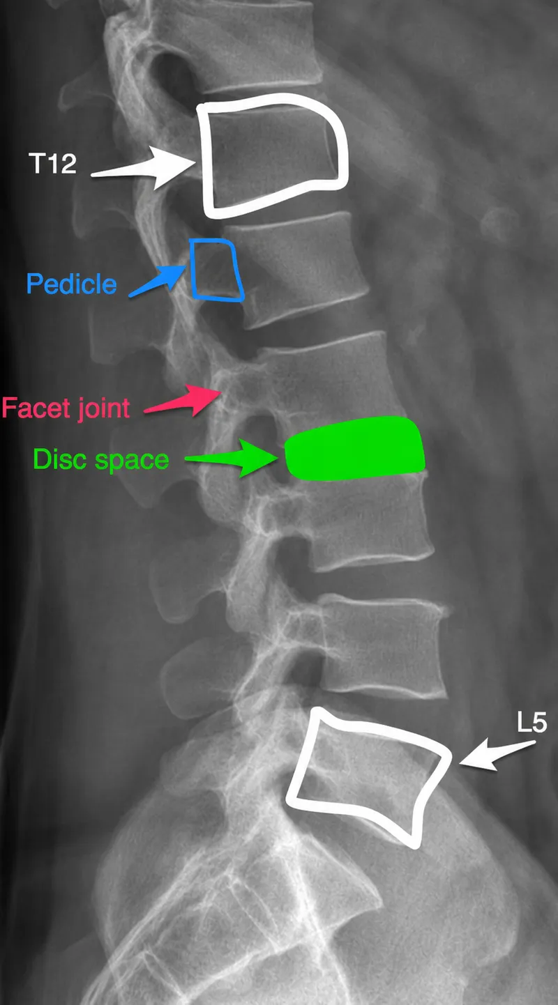 Lateral Lumbar Spine X-ray with Annotations