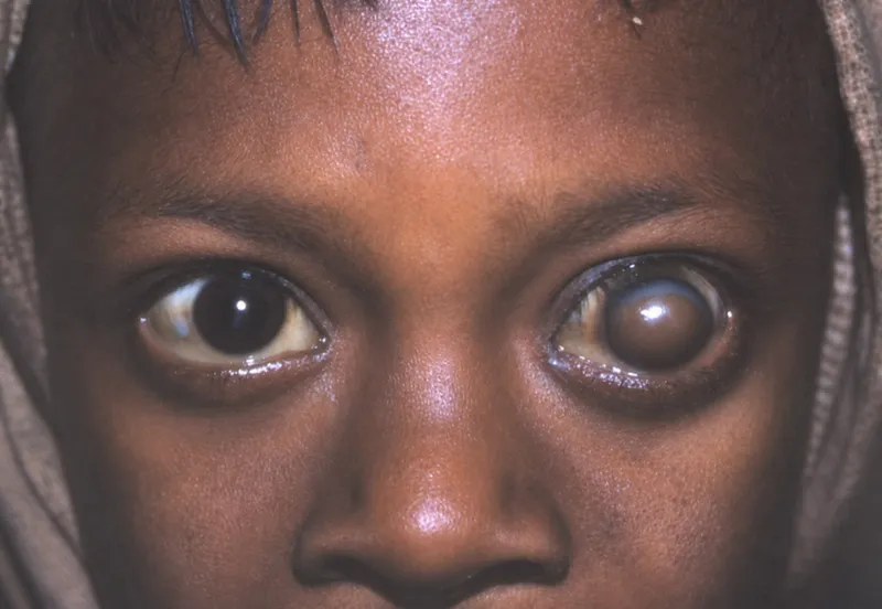 Vitamin A deficiency: Keratomalacia and Bitot's spots