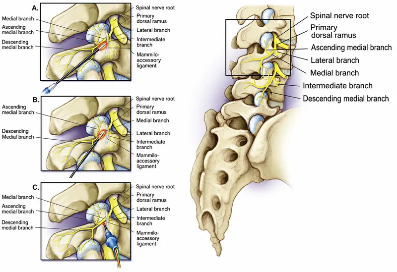 Zygapophyseal Joint Innervation and Nerve Block Procedures