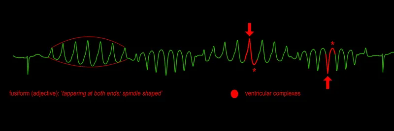 ECG: Torsades de Pointes with fusiform QRS