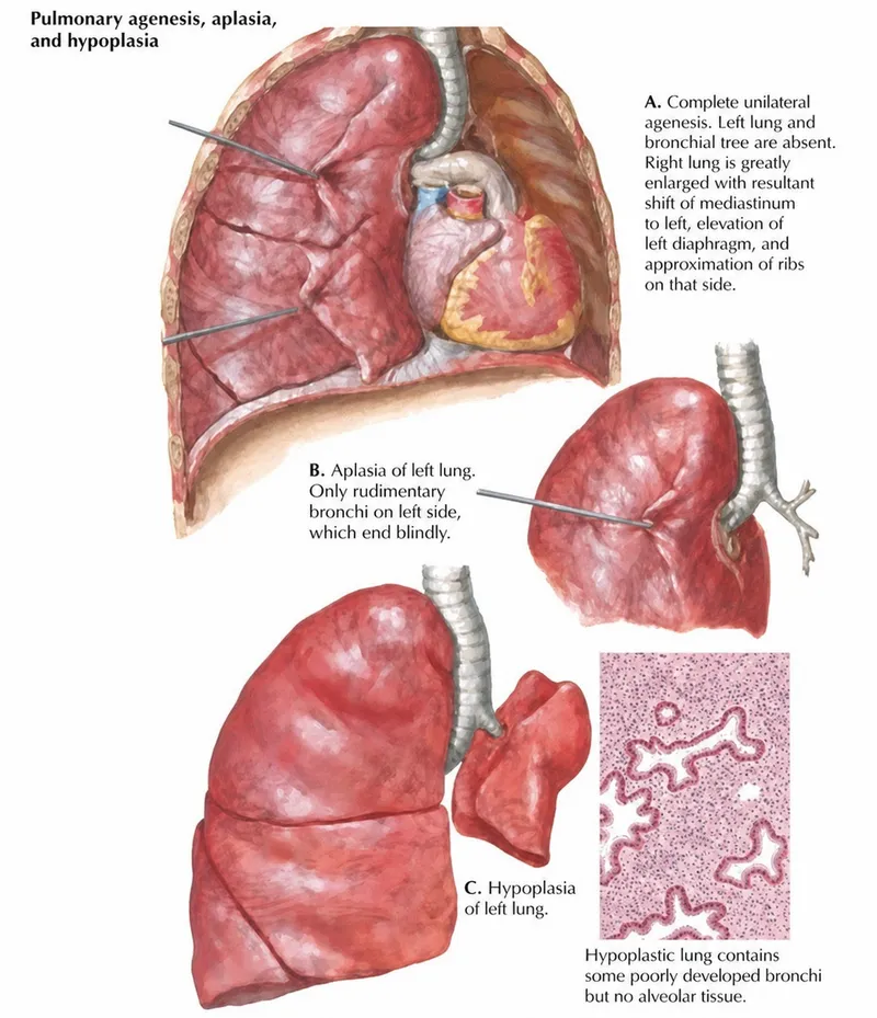 Pulmonary Agenesis, Aplasia, Hypoplasia