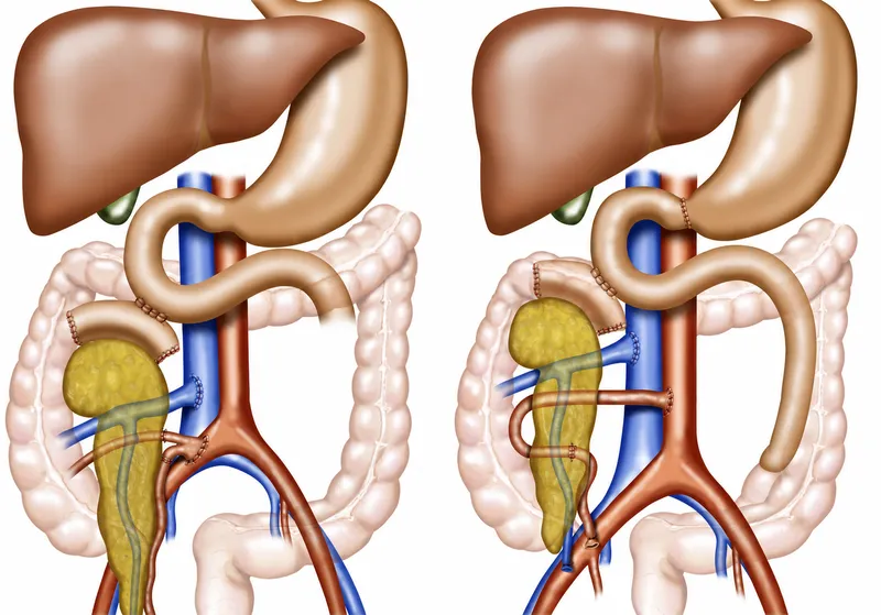 Pancreas Transplant: Enteric vs. Bladder Drainage