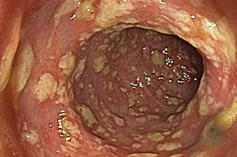 Endoscopic view of pseudomembranous colitis