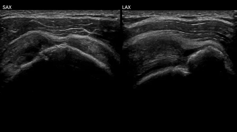 Rotator cuff tear ultrasound (SAX and LAX)