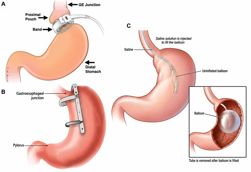Restrictive Bariatric Procedures