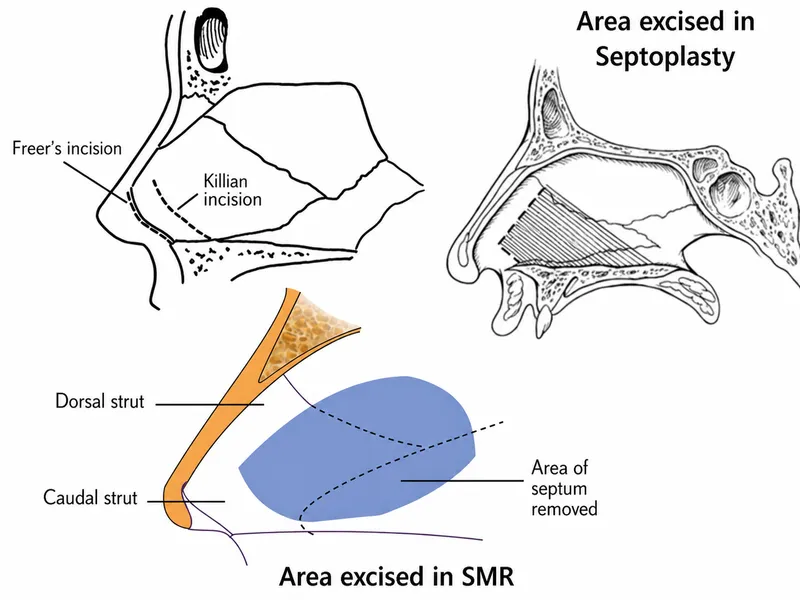 Septoplasty vs SMR surgical techniques for DNS