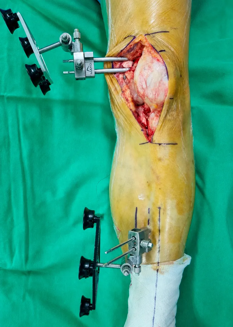 Computer-assisted total knee replacement surgery in progress