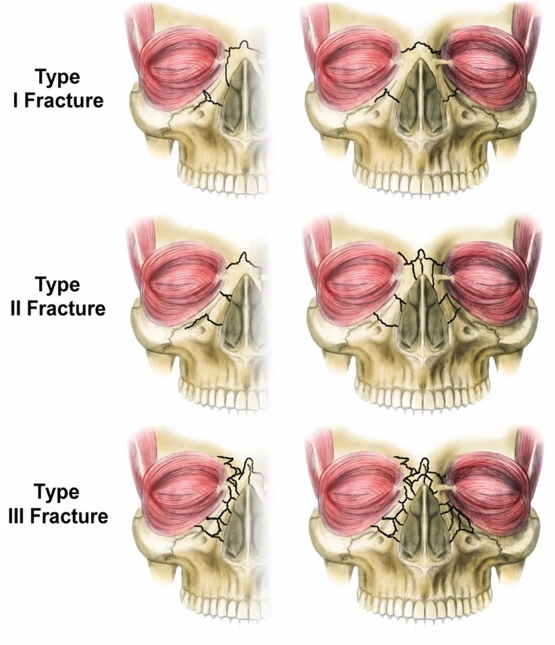 Nasal fracture types I, II, and III