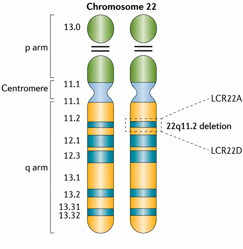 Chromosome 22 with 22q11.2 deletion region highlighted