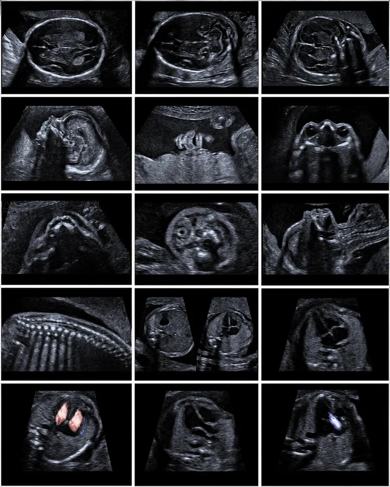 Fetal ultrasound images for prenatal anomaly detection