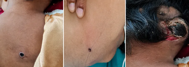 Painless eschar of scrub typhus in different body locations