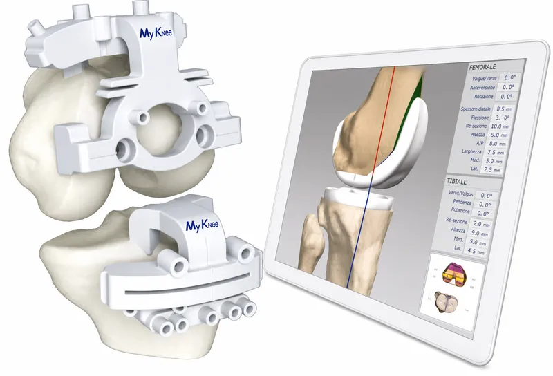 3D printed knee guides and digital planning