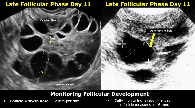 Ultrasound: Dominant Follicle Monitoring