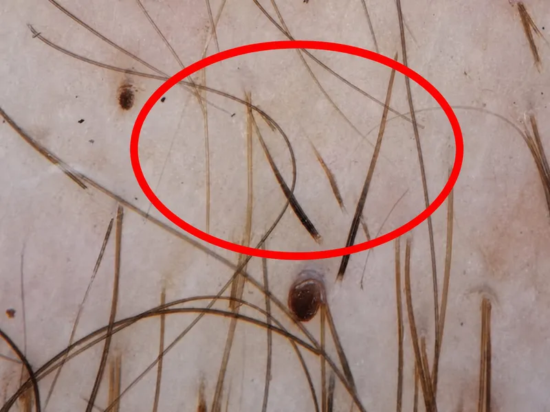 Dermoscopy image showing exclamation point hairs characteristic of alopecia areata