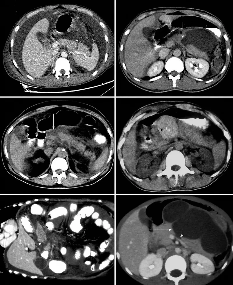 CECT scans of pancreatic trauma