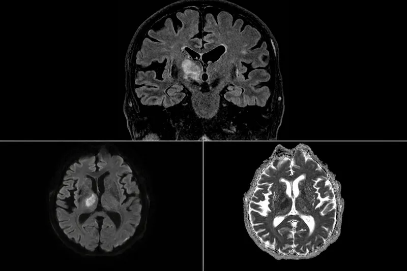 MRI Brain: FLAIR, DWI, and ADC in Acute Stroke