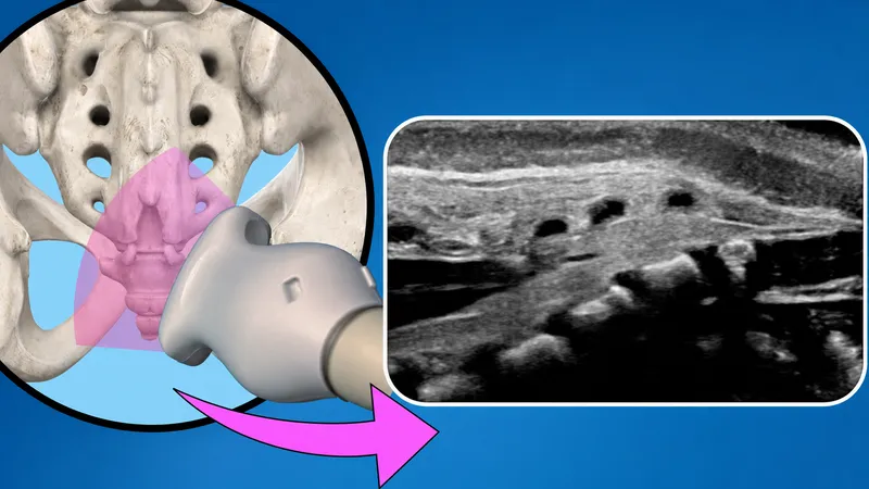 Ultrasound Guided Pediatric Caudal Block