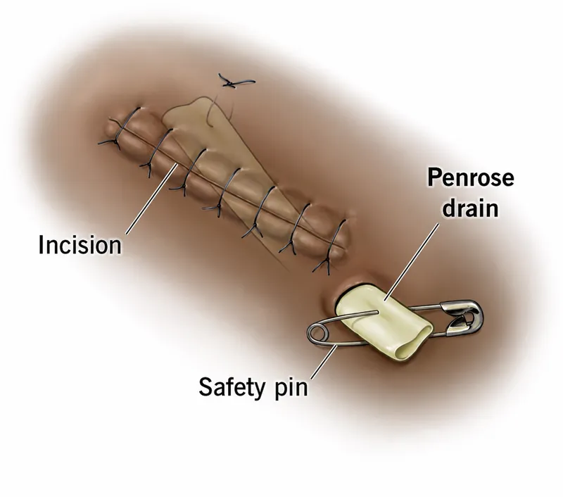 Penrose drain in surgical incision