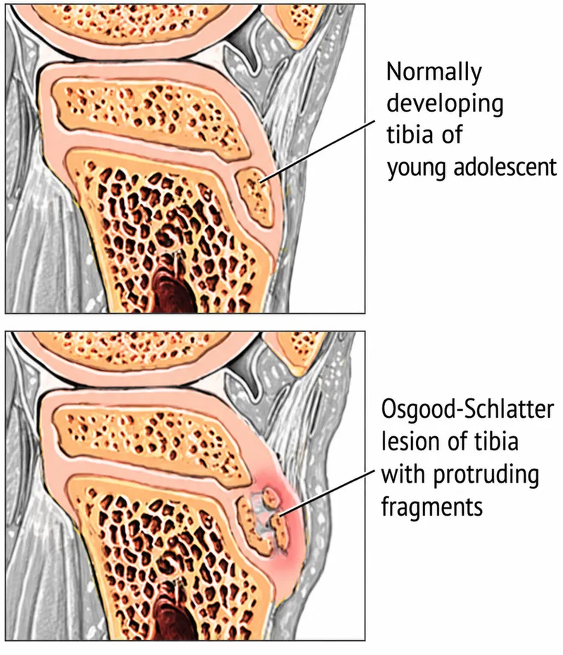 Osgood-Schlatter disease vs normal adolescent tibia