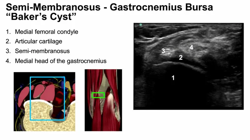 Ultrasound of Baker's Cyst with Anatomy Labels