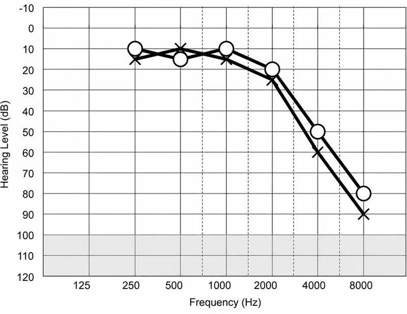 Audiogram: Bilateral Symmetrical High-Frequency Hearing Loss