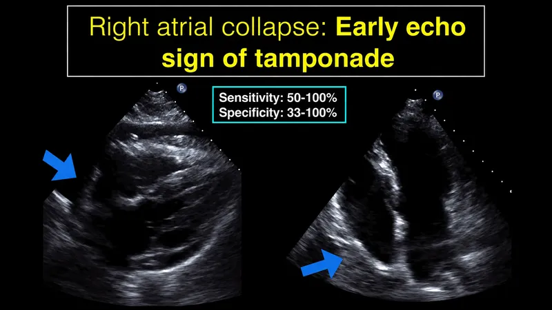 Echocardiogram: Right atrial collapse in cardiac tamponade