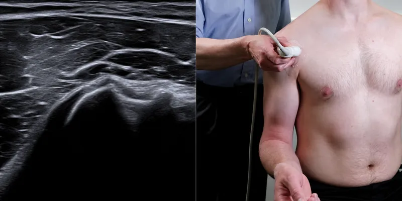 Shoulder US: Axial assessment at the bicipital groove