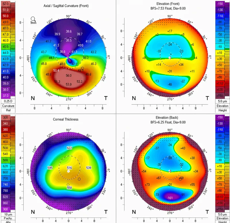 Corneal topography maps for keratoconus diagnosis