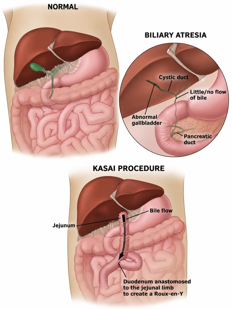 Biliary Atresia and Kasai Procedure Diagram