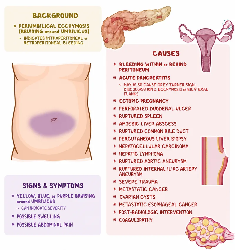 Cullen's sign in pancreatitis