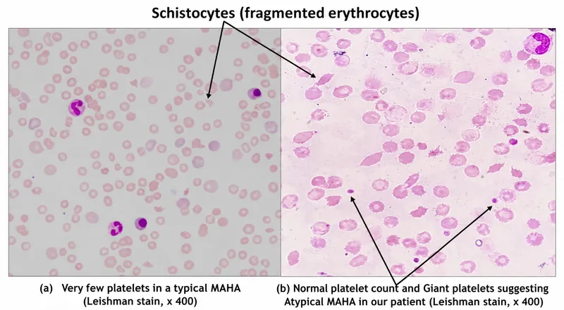 Schistocytes and platelets in MAHA peripheral blood smear